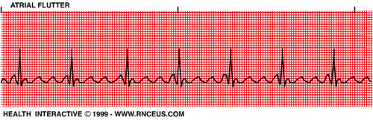 <p>the following rhythm strip</p>