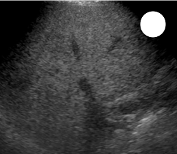 <p>how would you grade this liver for fatty infiltration</p>