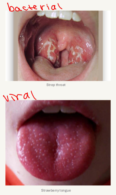 <ul><li><p>pharyngitis and tonsillitis </p><ul><li><p>primarily in children 5-15 yrs old</p></li><li><p>spread by droplets and close contact</p></li><li><p><strong><u>symptoms:</u></strong> sore throat, fever, malaise, headache, ab pain, nausea, tender cervical lymph nodes</p></li></ul></li><li><p>scarlet fever</p><ul><li><p>affects those w strep throat OR STREP SKIN INFECTIONS</p></li><li><p>streptococcal pyrogenic enterotoxins cause distinctive symptoms</p><ul><li><p><strong><u>scarlatiniform rash </u>- red w small papules (sandpaper texture) </strong></p></li><li><p>after rash, skin desquamation (peeling)</p></li><li><p><strong><u>strawberry tongue </u></strong></p></li></ul></li></ul></li></ul><p></p>