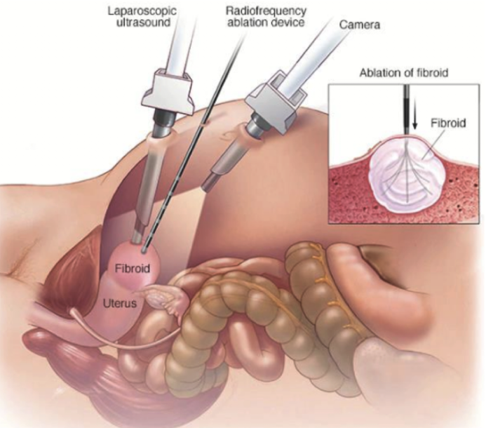 <p>Minimally invasive interventional procedure used to treat neoplastic disease</p><ul><li><p>uses sedation or general anesthesia</p></li></ul><p></p>