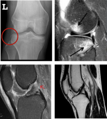 <p>X-ray: AP/Lateral, Segond fracture (pathognomonic for ACL)</p><p>MRI: Necessary to confirm dx, kissing contusion</p>