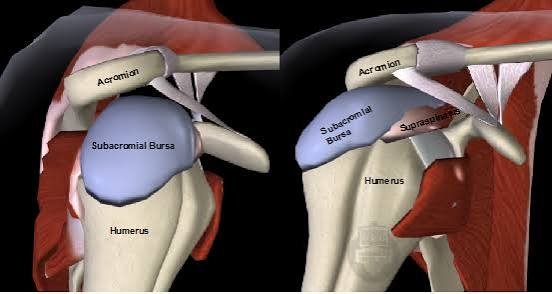 <p>Located between deltoid (muscle)+joint capsule</p><p>Doesn’t communicate with articular cavity</p><p>Fused with subacromial bursa</p>