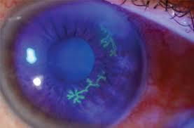 <p>Herpes Simplex Keratitis dx*</p>