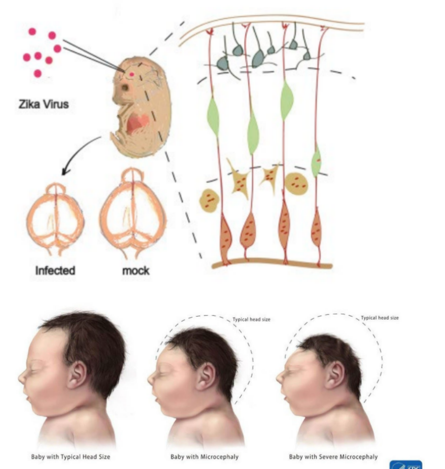 <p>Zika virus disrupts neural progenitor development → leads to microencephaly in <strong>mice</strong>, where:</p><ul><li><p>Zika virus <u>replicates</u> in embryonic mouse brain</p></li><li><p><u>infects</u> neural progenitors cells (NPCs)</p></li><li><p>leads to <u>defects in differentiation</u></p></li><li><p>induces <strong><u>immune response</u></strong><u> (</u><span style="color: blue;"><u>inflammation</u></span><u>) in the brain AND </u><strong><u>apoptosis</u> </strong>of post-mitotic neurons</p></li></ul><p>→ altogether: infected NPCs, differentiation defects, immune response, and apoptosis will cause <u>microencephaly that ranges in severity</u></p><p></p>