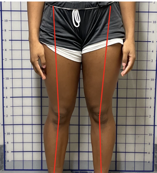 <p>knee valgus: why?</p>