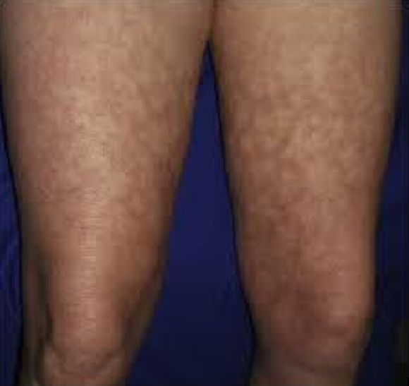 <p>Describe this lesion</p>