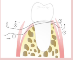 <p>Start facial 6 mm apical to coronal flap → pierce keratinized tissue → pierce lingual underside 6 mm from coronal → pierce lingual keratinized side 3 mm from coronal → pierce facial underside 3 mm from coronal → tie.</p><p>(Explanation: This technique everts narrow papillae, maximizing height preservation by suturing deeper (6 mm) and closer (3 mm) to the coronal edge, ensuring connective tissue contact without exposing the suture coronally.)</p>
