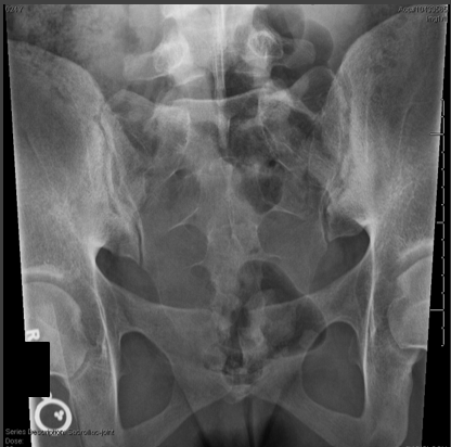 <p>critique for SI joint AP axial </p>