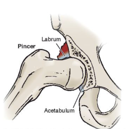 <p><span><strong>Cam Impingement</strong></span></p><ul><li><p><span>Femur side abnormality</span></p></li><li><p><span>Labral tearing</span></p></li><li><p><span>Articular cartilage degeneration</span></p></li><li><p><span>Vulnerable in flex or<br>abd</span></p></li></ul><p></p><p><span><strong>Pincer Impingement</strong></span></p><ul><li><p><span>Acetabulum side</span></p></li><li><p><span>Labral degeneration/calcification</span></p></li></ul><p></p>