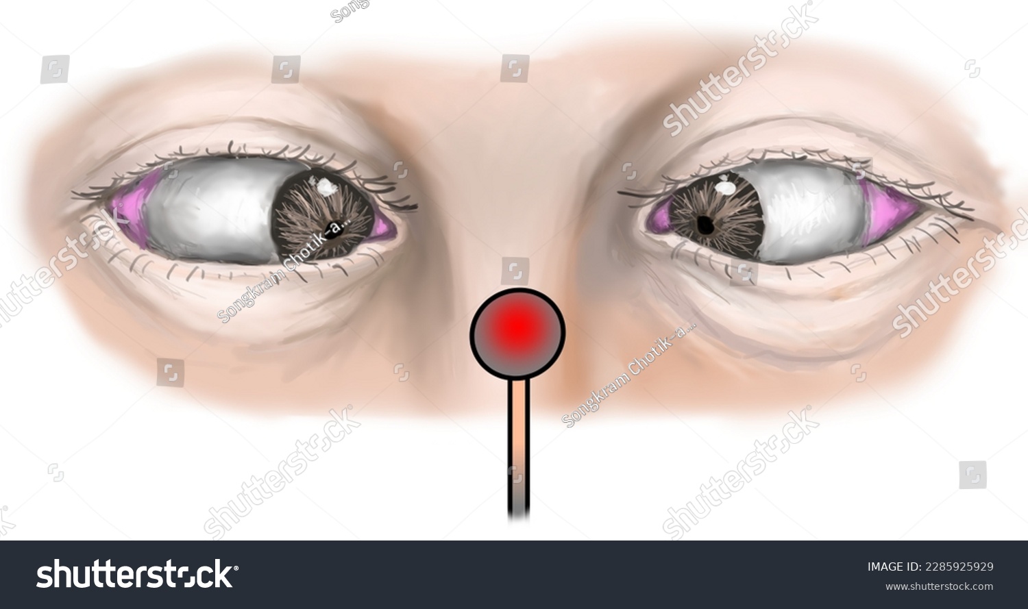 <p>adaptation of the eye for near vision by increasing curvature of lens</p>