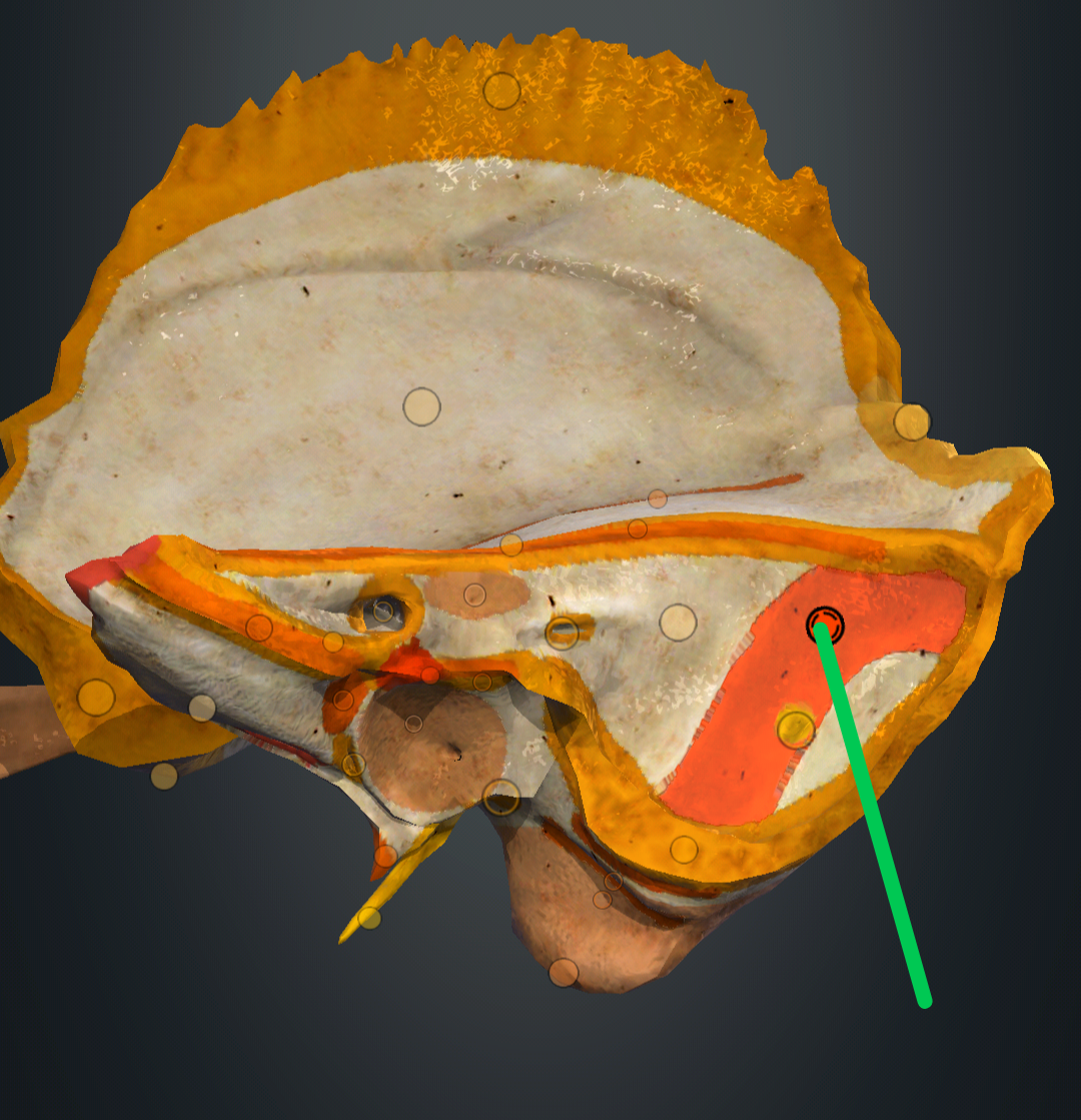 <p>sulcus sinus sigmoidei</p>
