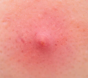 <p>type of papules that acne is an example</p>