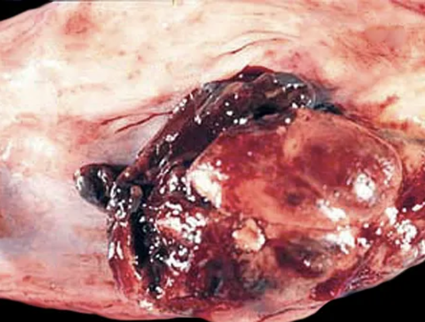 <p>1) Carcinome sarcomatoïde (sous type d’épidermoïde) </p><p>2)</p><ul><li><p>Mélange entre malpighien et fusiforme</p></li><li><p>Parfois différenciation sarcomateuse </p></li><li><p>Croissance polypoide </p></li></ul><p></p>