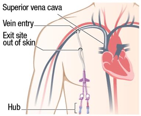 <p>CKD - dialysis catheter - vascular access </p>