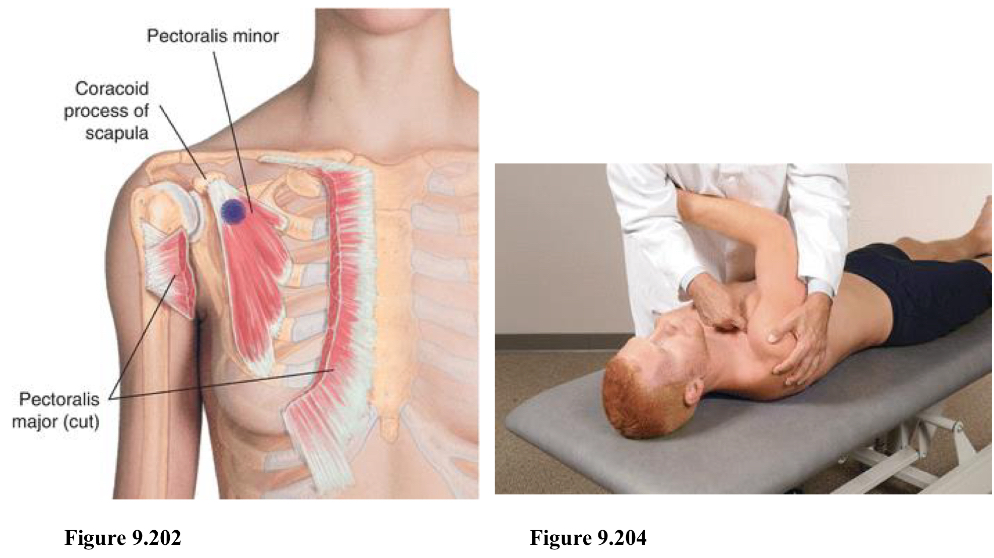 <p>F Add</p><p>Location is inferior and medial to the coracoid process</p><ol><li><p>Pt supine</p></li><li><p>Physician stands opposite of tender point</p></li><li><p>Point is inferior and medial to coracoid process</p></li><li><p>Arm is adducted across chest, shoulder/scapula is pulled anterior, inferior, and medial</p></li><li><p>Shoulder should be OFF table</p></li><li><p>Can stabilize by holding arm or forearm</p></li></ol><p></p>
