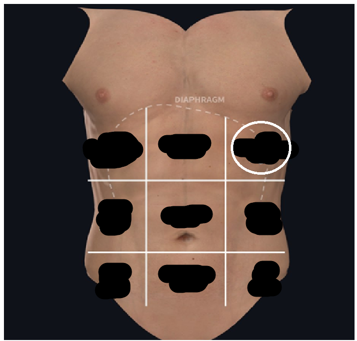 <ul><li><p><span style="background-color: transparent;">Lateral to epigastric</span></p></li><li><p><span style="background-color: transparent;">Beneath lower ribs</span></p></li></ul><p></p>