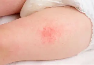 <ol><li><p><span style="color: rgb(83, 143, 215);"><strong>hydrate </strong></span>skin (non scented)</p></li><li><p><span style="color: rgb(246, 76, 212);"><strong>tepid </strong>baths</span></p></li><li><p><span style="color: rgb(128, 139, 27);"><strong>fragrance free</strong> lotion</span></p></li></ol><p></p>