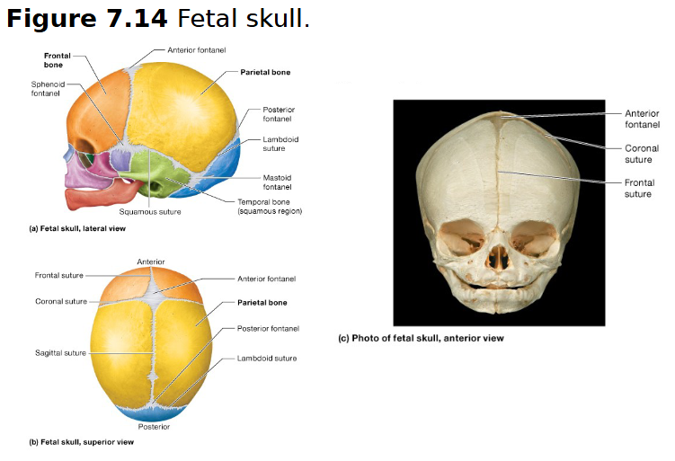 <p>only in fetal skulls</p><p><span><span>At the junction of the lambdoid and squamous sutures where the developing parietal, temporal, and occipital bones meet</span></span></p>