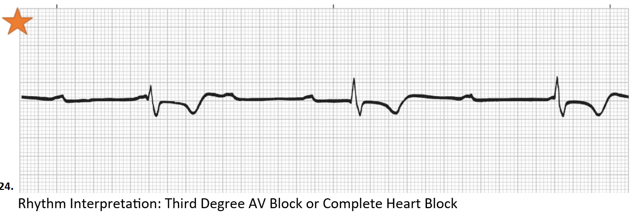 <p>Third Degree AV Block or Complete Heart Block</p>