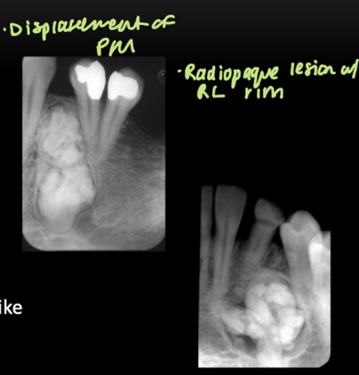 <p>- Density: mixed RL-RP</p><p>- Internal architecture: amorphous or tooth-like</p>