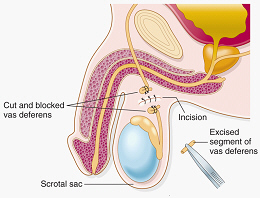 <p><span>The picture shows Vasectomy Procedure</span></p>