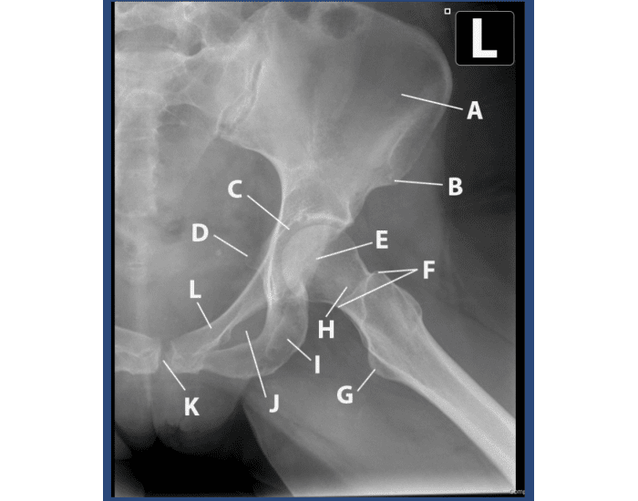 <p>Why do we abduct the femur 45 degrees from vertical for the Frogleg projection (modified cleaves)? </p>
