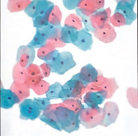 <p>1. What stain is demonstrated in this image? </p><p>2. What type of cells are stained? </p><p>3. What reagent stains some cell cytoplasm pink?</p>
