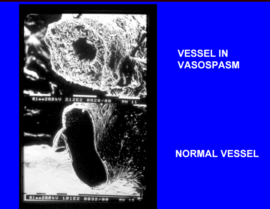 <p>pathologic response due to irritation of cerebral arteries by blood breakdown products </p><ul><li><p>associated with subarachnoid hemorrhage </p></li></ul><p>results in structural wall changes and lumenal narrowing </p><p></p>