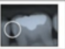 <p>radiolucency in the outer ½ of the enamel</p>