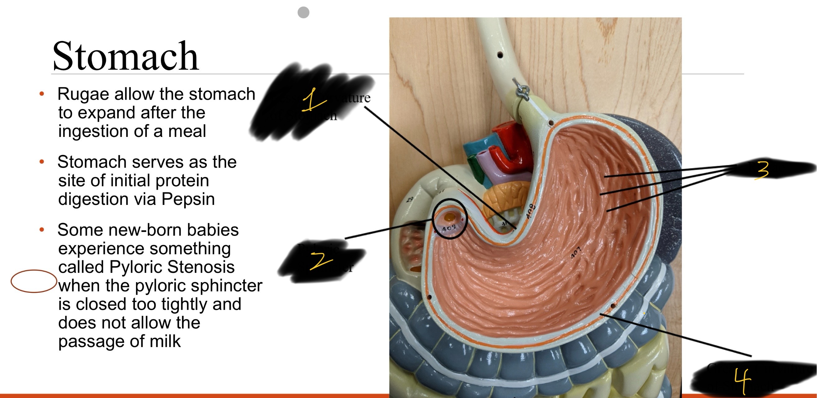 <p>some new-born babies experience something called —— when the pyloric sphincter is closed too tightly and does not allow the passage of milk </p>