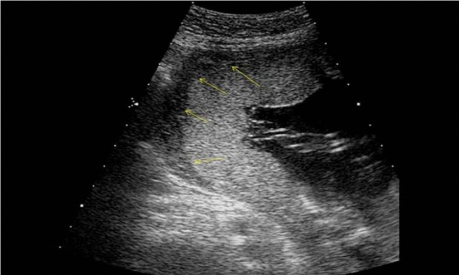 <p>What are the arrows pointing to on the image?</p><p>A. hematoma formation within a placental abruption</p><p class="p1">B. placental lake formation posterior to the placenta</p><p class="p1">C. normal retroplacental space</p><p class="p1">D. amnion and chorion junction</p>