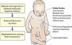 <p>Amniotic fluid = fetal urine</p><p>- Severe renal malfunction → ↓ Amniotic fluid → Fetus exposed to absent or ↓ amniotic fluid → loss of cushioning to external forces → fetal compression</p>