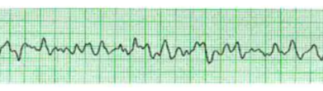 <p>what does this EKG show? (cooked) </p>