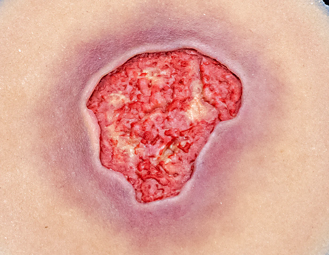 <p>What pressure sore does this depict?</p>