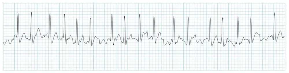 <p>what dysrhythmia is this</p>