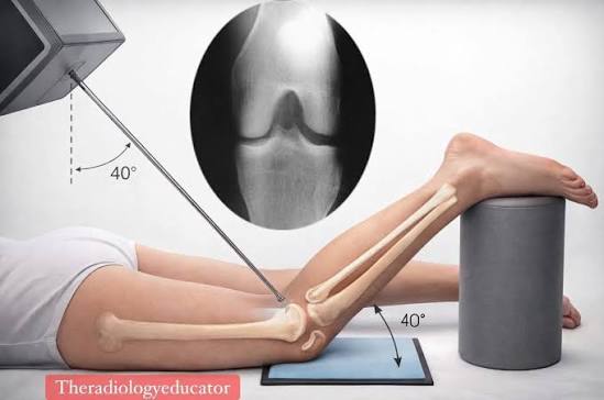 <p>PA axial projection used to visualize the intercondylar fossa of the knee. Patient is prone</p>