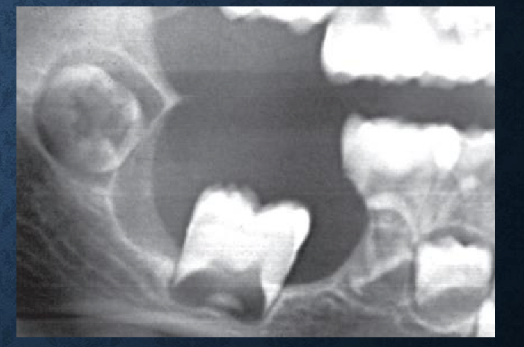 <p>a lesion that apically displaces teeth is typically…</p>