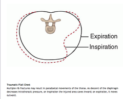 <p>multiple rib fractures</p>