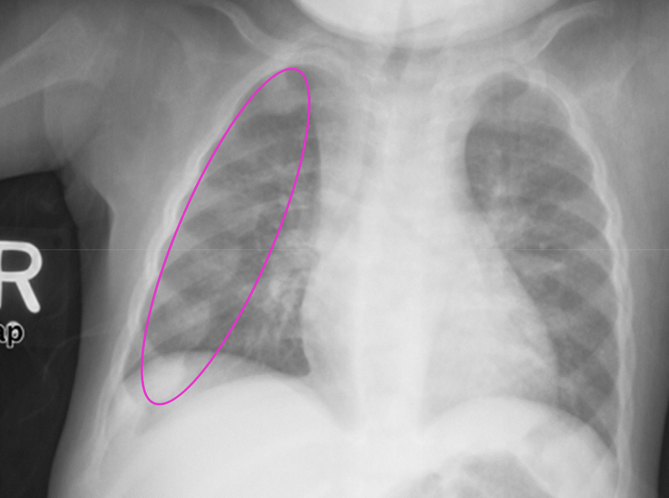<p>What radiographic finding is in this image of Rickets</p>