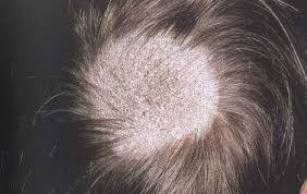 <p>tinea capitus and sx</p>