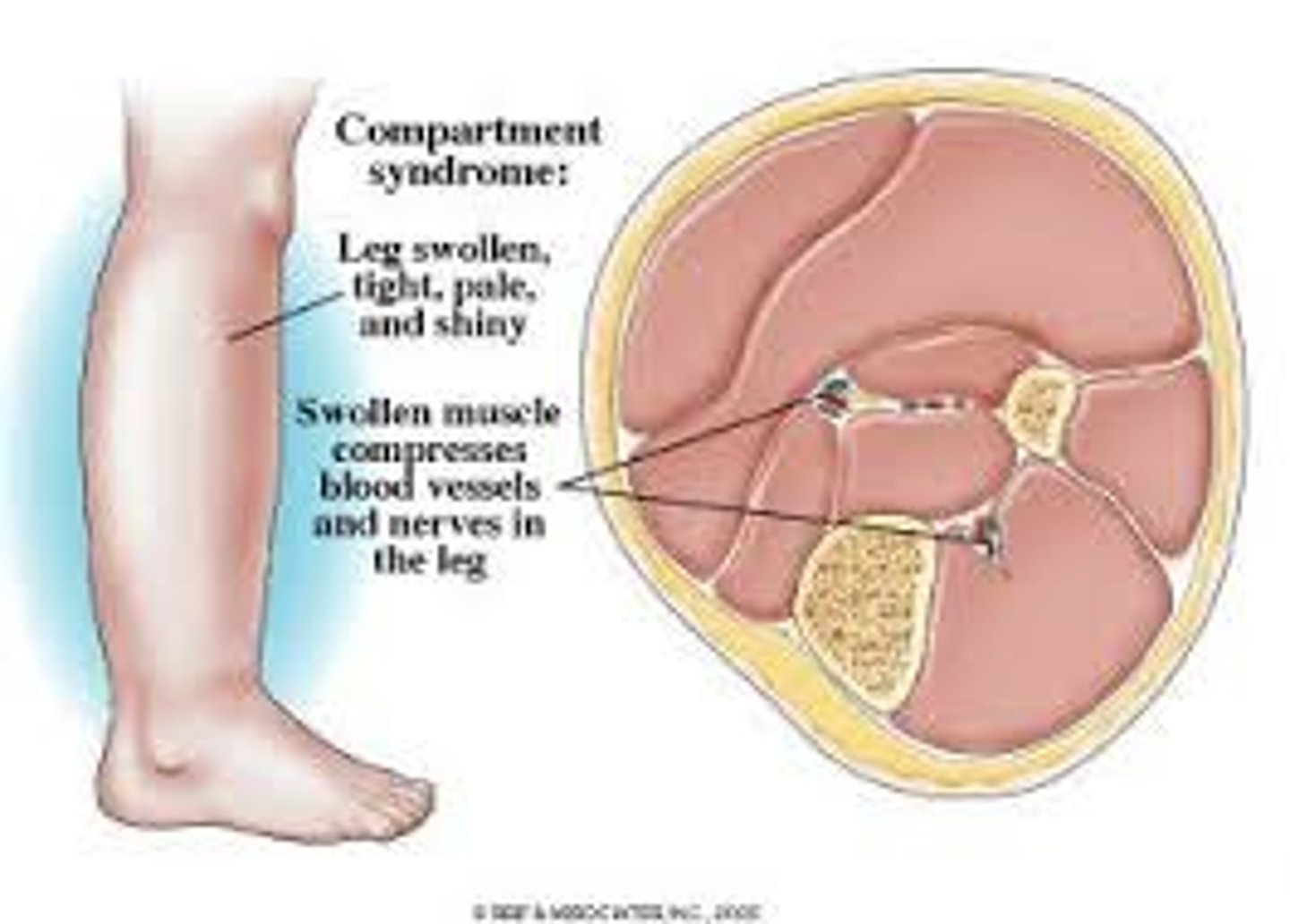 <p>-increases pressure in muscle compartment, burst blood vessel is a common cause (something leaking that shouldn't be, and in a muscle compartment there is nowhere for the fluid to go)</p><p>-need to get rid of compression to avoid necrosis</p><p>-cause: trauma, snake venom</p>