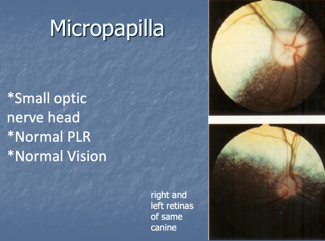 <p>a small optic n. head, but has normal PLR and normal vision.</p>