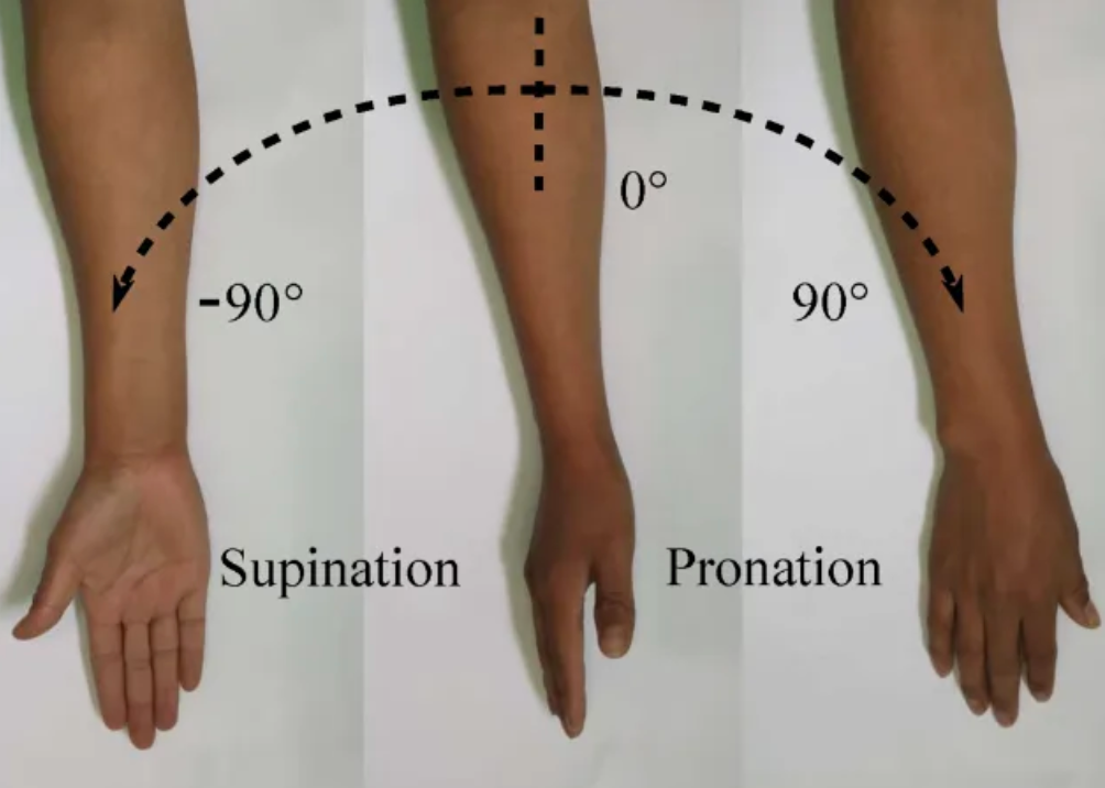 <p>turning the forearm so the <strong>palms face backwards/down</strong></p><ul><li><p>detail: the <em>radius rotates and crosses over the ulna</em>. the<em> palms face backward (posteriorly)</em></p></li><li><p>example: <u>basketball players pronate to dribble a ball</u></p></li></ul><p></p>