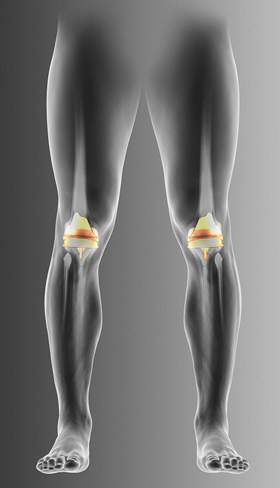 <p>Bilateral </p>