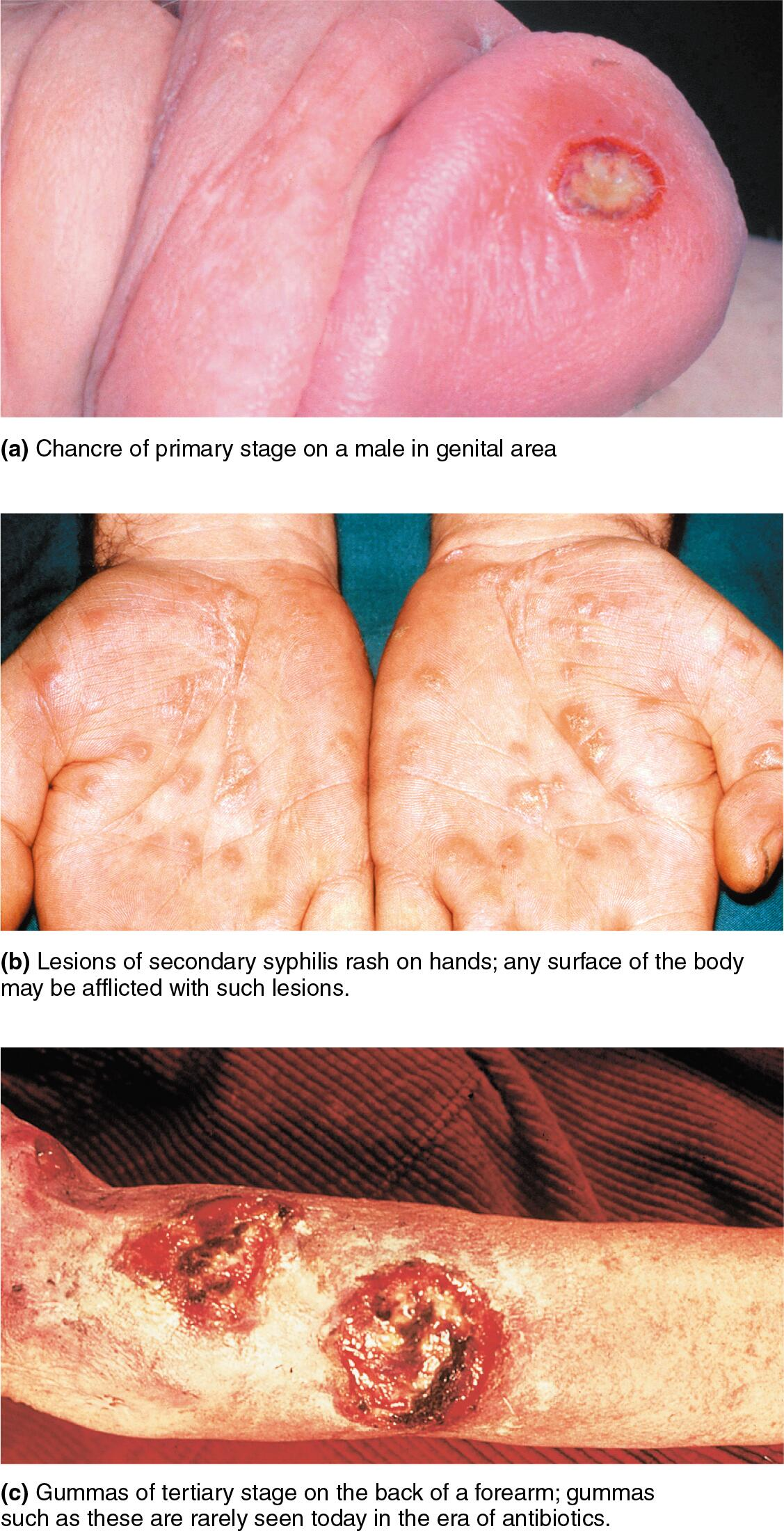 <ul><li><p><span style="font-size: calc(var(--scale-factor)*10.00px);">Skin and mucosal rashes, especially on the palms and soles</span></p><ul><li><p><span style="font-size: calc(var(--scale-factor)*10.00px);">Due to an inflammatory response</span></p></li><li><p><span style="font-size: calc(var(--scale-factor)*10.00px);">Rash lesions are infectious</span></p></li></ul></li></ul><p></p>