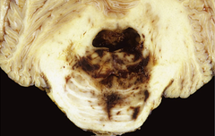 <p>What is the prognosis with Duret hemorrhages?</p>