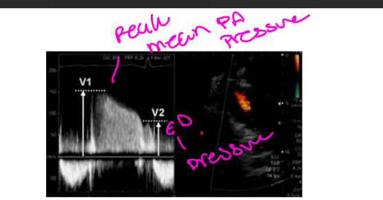 <ul><li><p>Mean PA pressure</p></li><li><p>RVSP</p></li><li><p>Qp:Qs</p></li><li><p>PISA</p></li></ul><p></p>