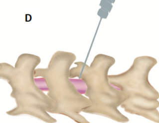 <p>a way to deliver medication to the subarachnoid space of the spinal cord so that it reaches the CSF (very difficult!) direct, but not prolonged</p>