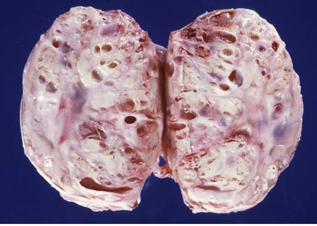 <p><span><strong>Du obducerar ett sto och ena äggstocken är tumöromvandlad, se bilden nedan (storleken är 20x12cm).</strong></span></p><p class="MsoNormal"><span><strong>b) </strong>Ge ETT exempel på hur denna tumör kan ha påverkat hästen, och förklara varför. <strong>(2p)</strong></span></p><p class="MsoNormal"><span>&nbsp;</span></p>