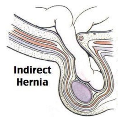 <p>Indirect Hernia</p>